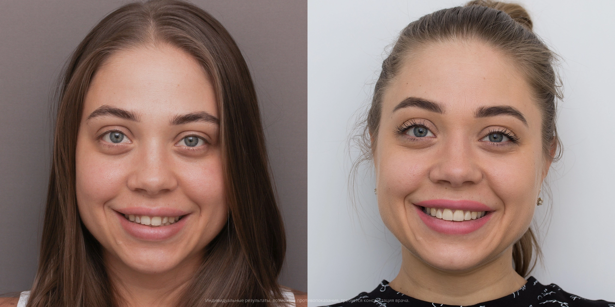 До-после лица