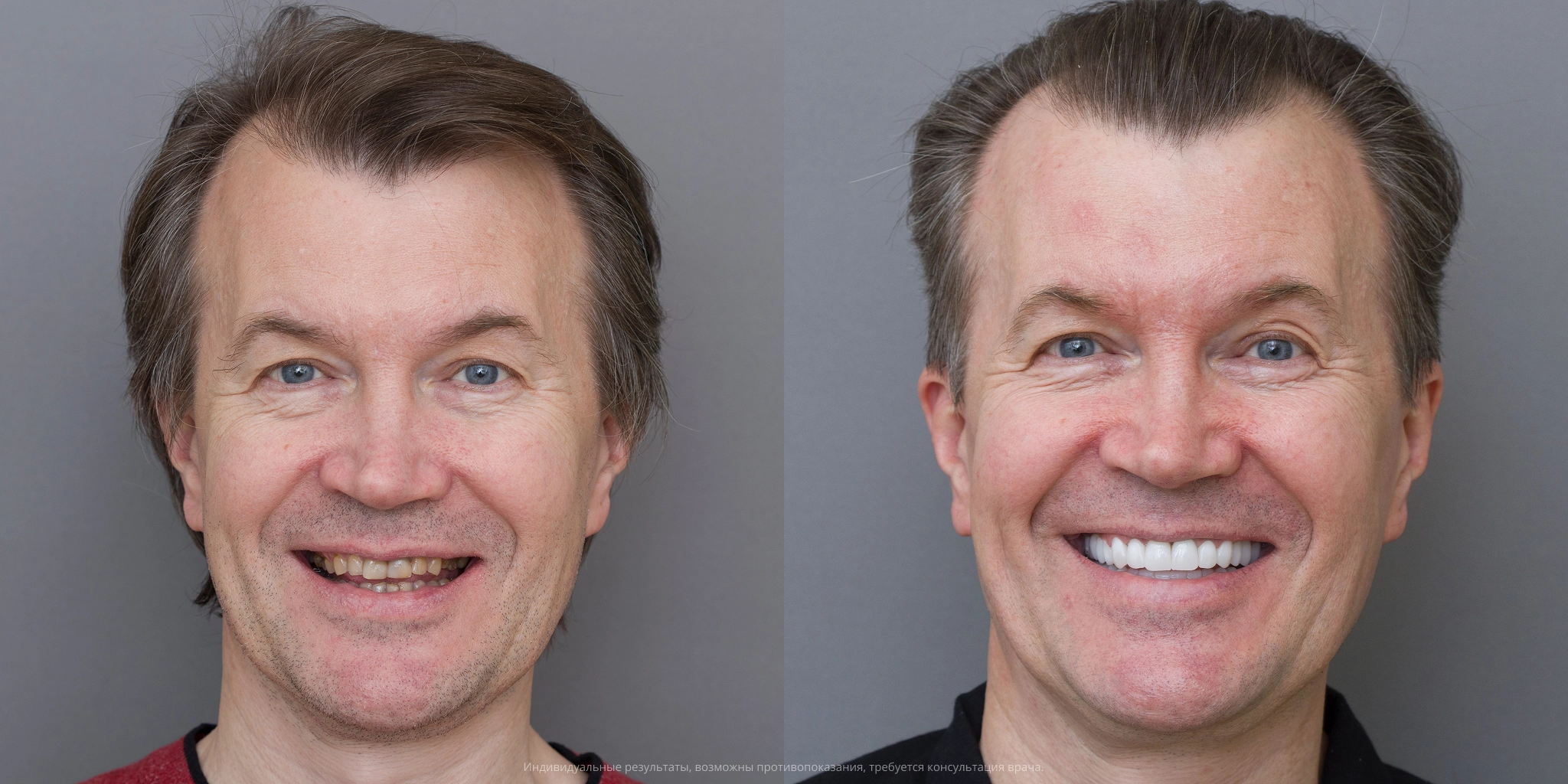 До-после лица