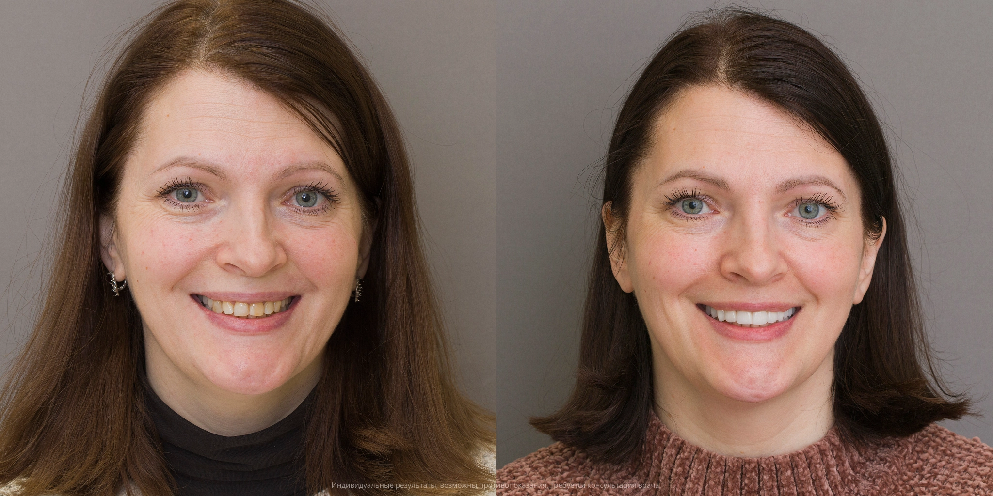 До-после лица
