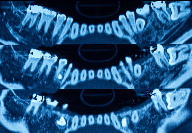 КТ челюсти в Мурино