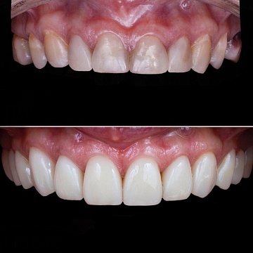 Лечение зубов